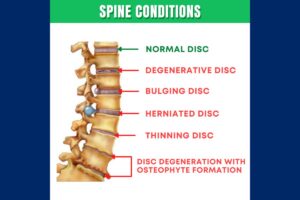 Spinal Discs